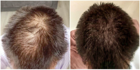 Male hair loss patient results after 4 PRP treatments